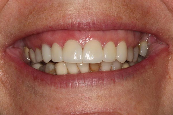 whitetened teeth after a dental procedure from Lakewinds Dental Centre