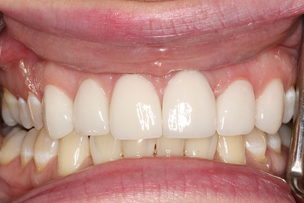 realigned and fixed teeth after a dental procedure from Lakewinds Dental Centre