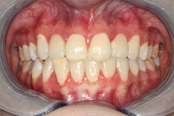 realigned teeth after a dental procedure from Lakewinds Dental Centre